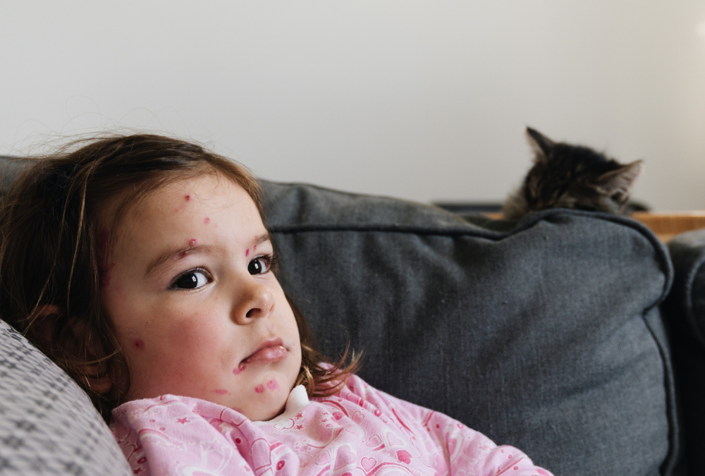 “Spotting” the Signs of Mumps & Measles