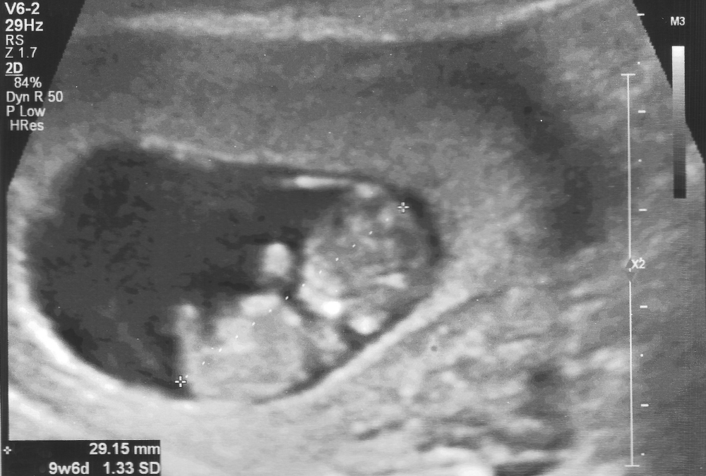 From Cravings to the First Heartbeat: The First Trimester